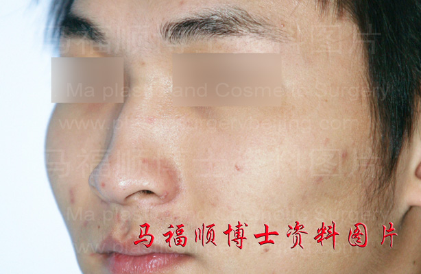 高颧弓颧骨照片