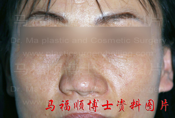 颧骨颧弓高照片