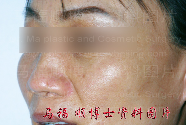 颧骨颧弓高照片