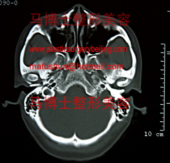 瘦长形脸颧骨颧弓截面
