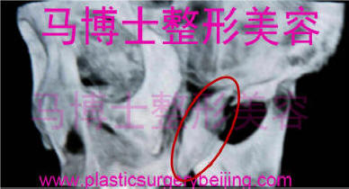 颧骨颧弓整形术后下垂