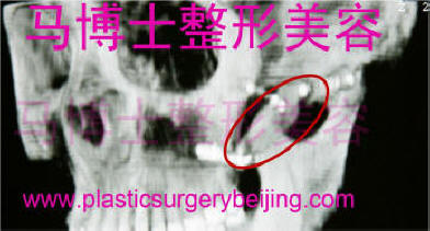 颧骨颧弓下垂复位后