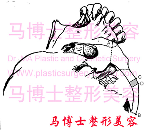 复合截骨颧弓降低术示意图-术前设计