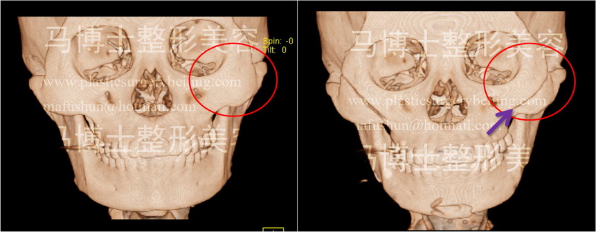 颧骨颧弓整形术后无效果