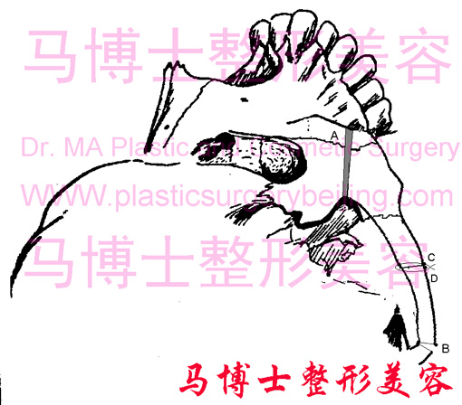 复合截骨颧弓降低示意图-颧弓降低后固定