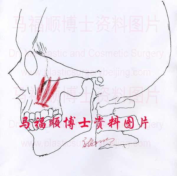 正常的颧骨颧弓及部分表情肌示意图