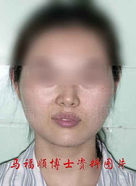 磨颧骨后不下垂