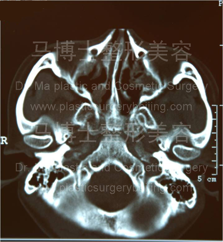 颧骨颧弓舒平术前CT