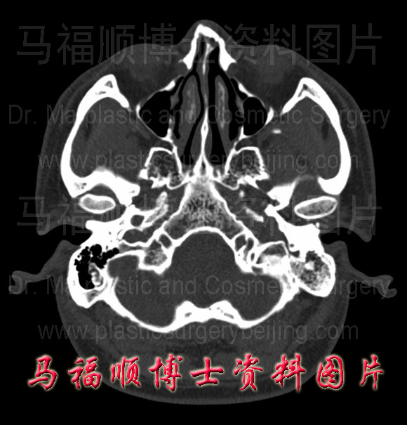 颧弓的CT截面图片