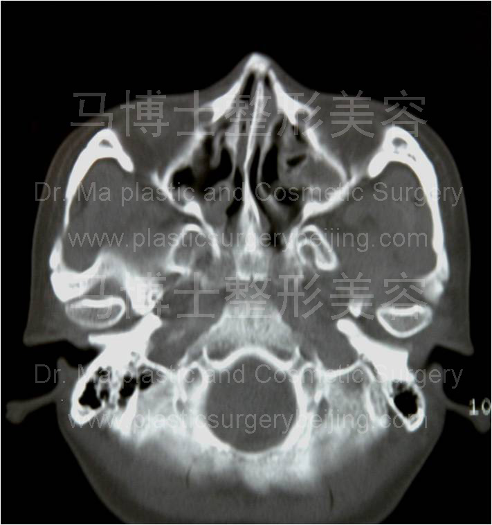 颧骨颧弓舒平术后CT