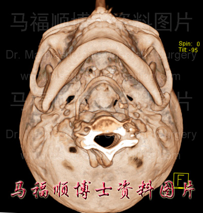 窄颧弓者三维CT图片