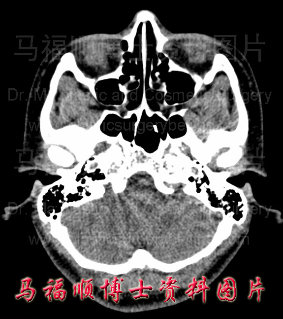 宽颧弓者的断层CT片