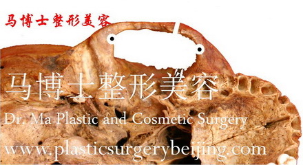 复合截骨颧骨颧弓整形术示意--去除骨段