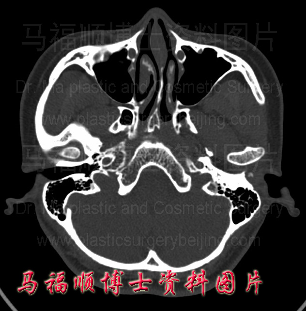 宽颧弓者的断层CT片