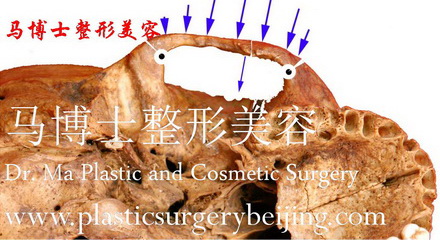复合截骨颧骨颧弓整形术示意-术后
