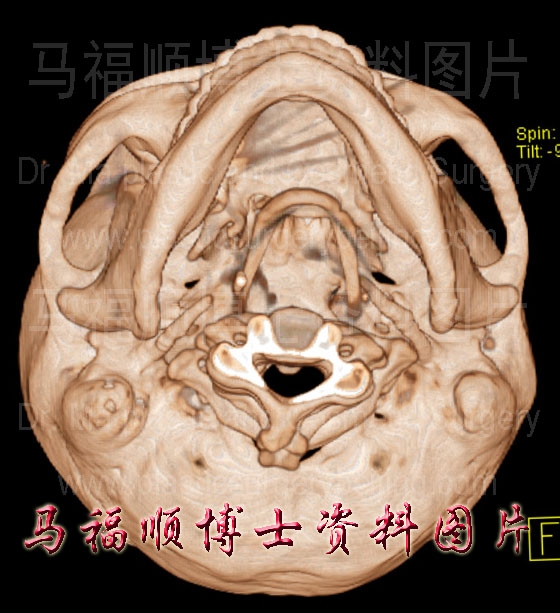 宽颧弓的三维CT图片