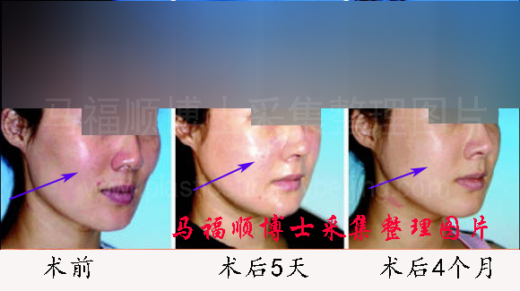 颧骨颧弓内推后下垂