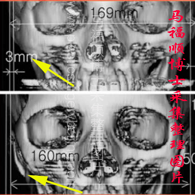 颧骨颧弓内推后下垂CT片