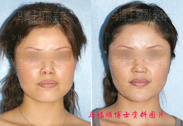 鼻延长及上下颌前突整形手术前后