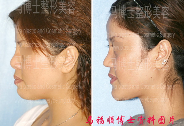 鼻延长及上下颌前突整形手术前后侧位