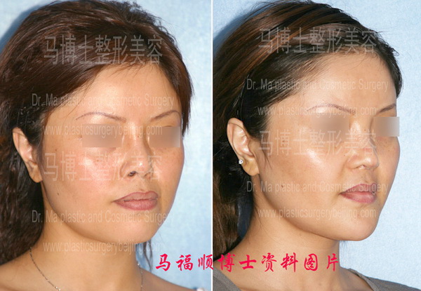 鼻延长及上下颌前突整形手术前后45度