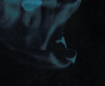 颏前移后固定物及台阶状外观 颏前移后固定物及台阶状外观