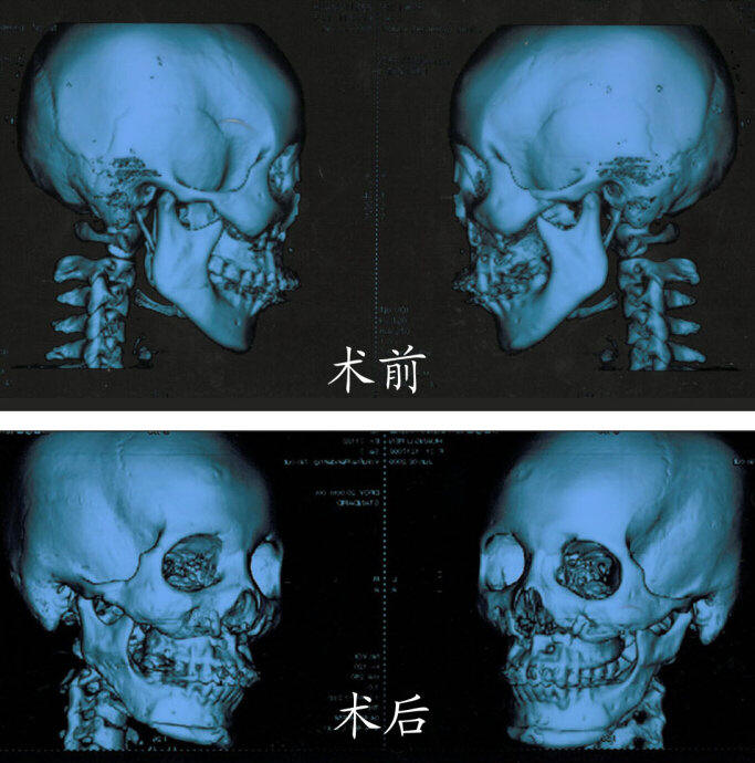颌面整形前后CT对比 颌面整形前后CT对比