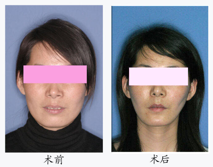 颌面整形术前及术后正面 颌面整形术前及术后正面
