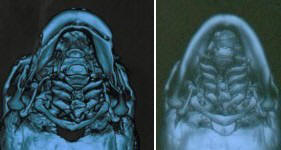 下颌角整形及颏前移后之CT改变 下颌角整形及颏前移后之CT改变