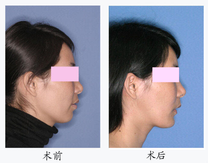 颌面整形术前及术后右侧面 颌面整形术前及术后右侧面