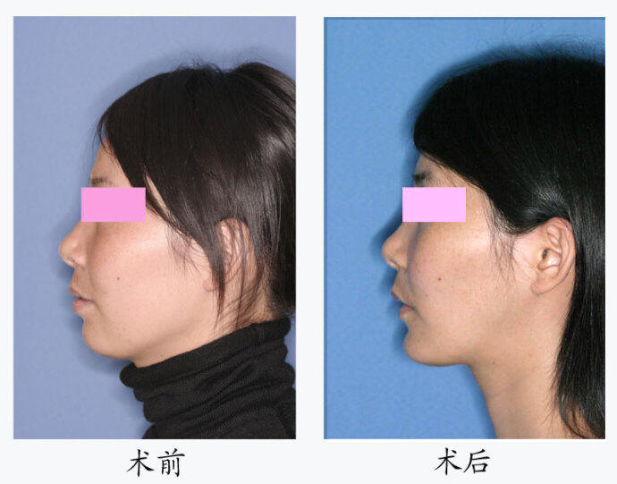 颌面整形术前及术后左侧面 颌面整形术前及术后左侧面