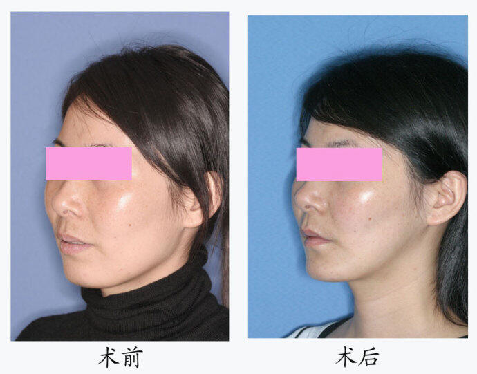 上下颌前突整形术后并发症 上下颌前突整形术后并发症