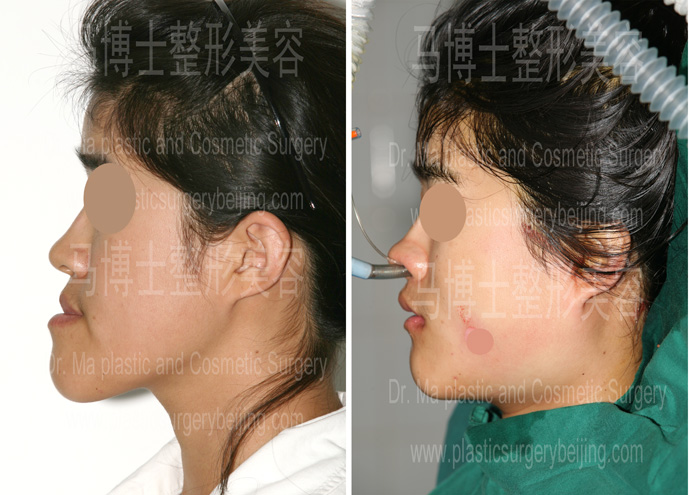 反颌畸形整形手术前后照片