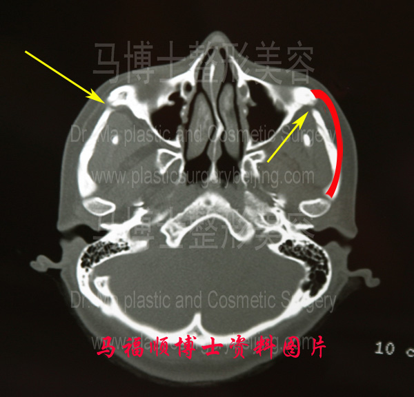 颧骨颧弓前端截骨后CT断层所留下的痕迹