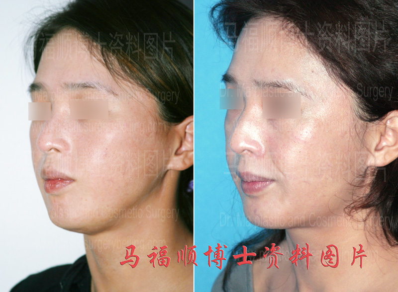 下颌骨切除过多修复前后对比 下颌骨切除过多修复前后对比