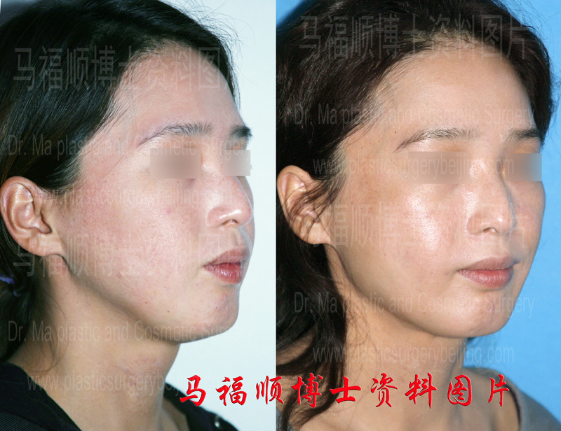 切除过多下颌角骨修复前后侧位 切除过多下颌角骨修复前后侧位