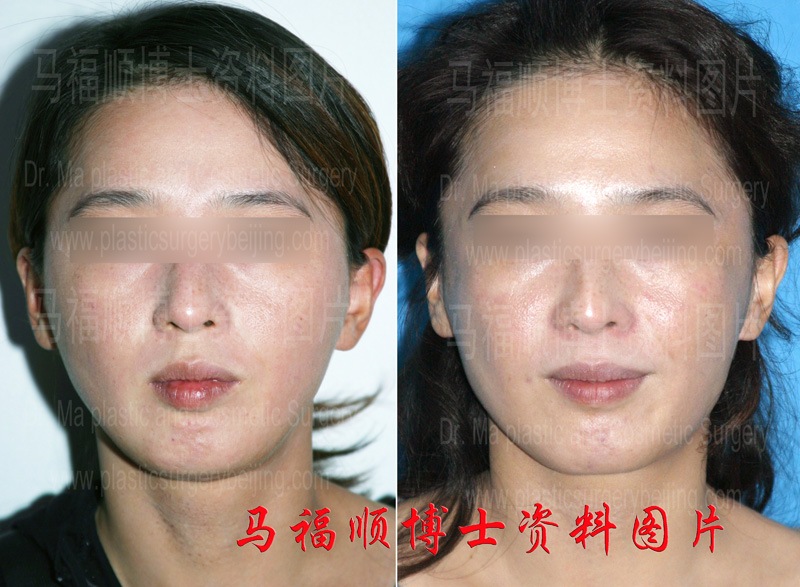 切骨过多下颌角修复 切骨过多下颌角修复