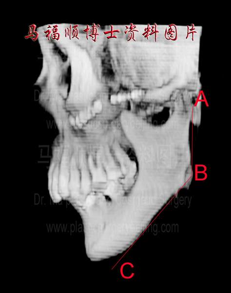 下颌角切除过多CT图片