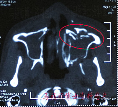 颌面外伤早期修复