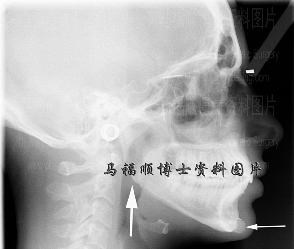 掩饰性手术X线片