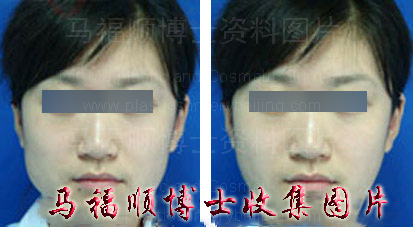 非手术所得的对比照片