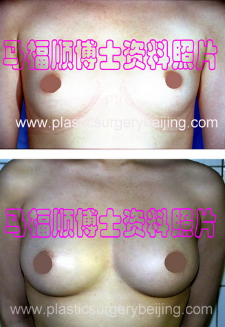 自体脂肪隆胸效果比较正面