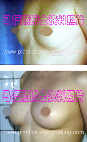 自体脂肪隆胸效果比较斜面