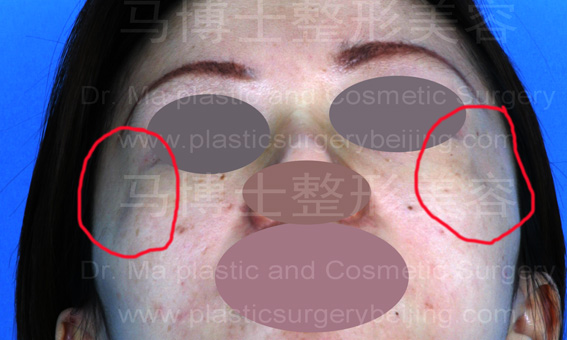 颧骨颧弓整形术后颧部凹陷