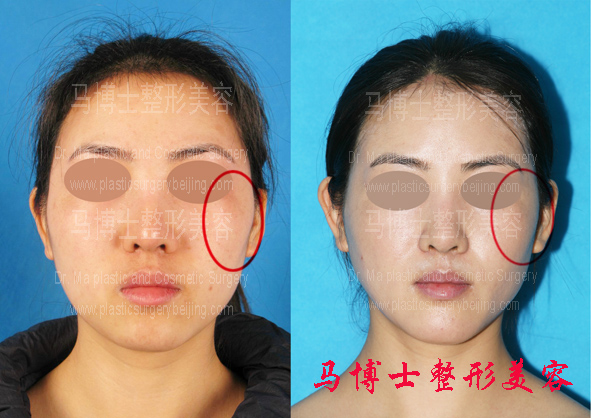 颧骨颧弓整形颏前移整形术前术后对比正面