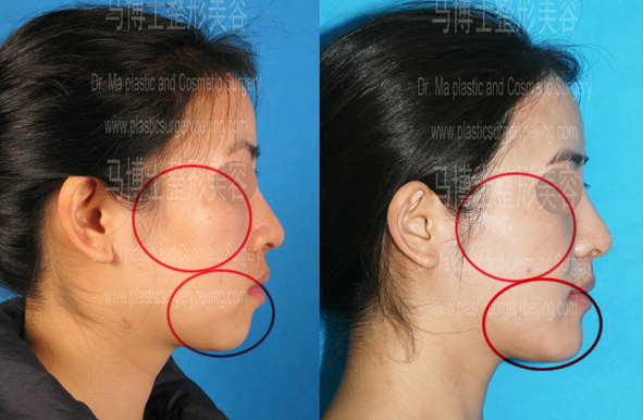 颧骨颧弓整形颏前移整形术前术后对比侧面