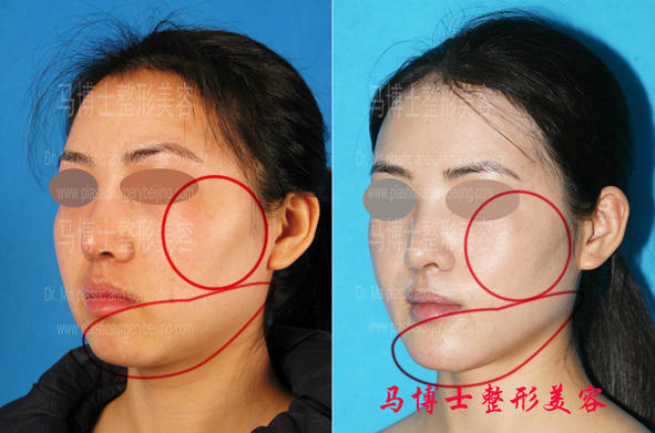 颧骨颧弓整形颏前移整形术前术后对比45度角