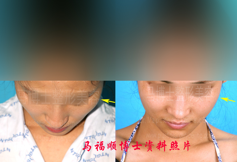 颧骨缩小整形颧弓内推后两个月低头位