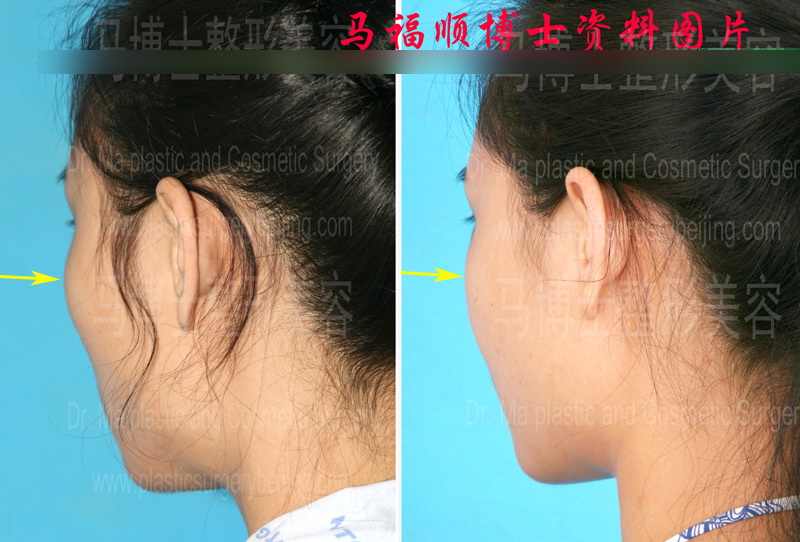 颧骨缩小整形颧弓内推后两个月斜后位对比照片