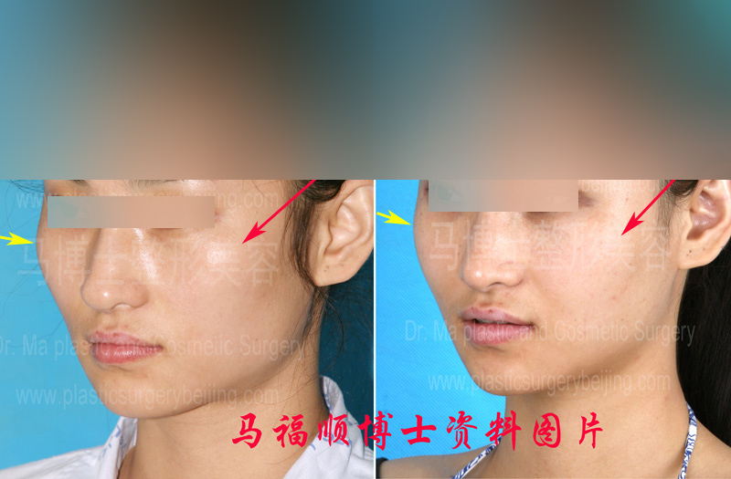 颧骨整形颧弓内推后两个月
